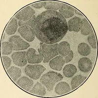 An illustration from The malarial fevers, haemoglobinuric fever and the blood protozoa of man / by Charles F. Craig ; illustrated by four colored plates, twenty-five clinical charts, and twenty-eight photomicrographs and drawings. (1909)