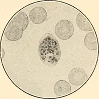 Picture 4 of 34 from The malarial fevers, haemoglobinuric fever and the blood protozoa of man / by Charles F. Craig ; illustrated by four colored plates, twenty-five clinical charts, and twenty-eight photomicrographs and drawings. (1909), leaf 45