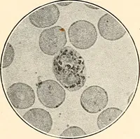 An illustration from The malarial fevers, haemoglobinuric fever and the blood protozoa of man / by Charles F. Craig ; illustrated by four colored plates, twenty-five clinical charts, and twenty-eight photomicrographs and drawings. (1909)
