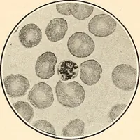 Picture 10 of 34 from The malarial fevers, haemoglobinuric fever and the blood protozoa of man / by Charles F. Craig ; illustrated by four colored plates, twenty-five clinical charts, and twenty-eight photomicrographs and drawings. (1909), leaf 53