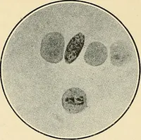 An illustration from The malarial fevers, haemoglobinuric fever and the blood protozoa of man / by Charles F. Craig ; illustrated by four colored plates, twenty-five clinical charts, and twenty-eight photomicrographs and drawings. (1909)