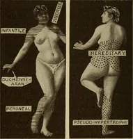 An illustration from The diagnostics of internal medicine : a clinical treatise upon the recognised principles of medical diagnosis, prepared for the use of students and practitioners of medicine / by Glentworth Reeve Butler ... ; with five coloured plates and two hundred and seventy-two illustrations and charts in the text. (1909)