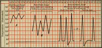 An illustration from The diagnostics of internal medicine : a clinical treatise upon the recognised principles of medical diagnosis, prepared for the use of students and practitioners of medicine / by Glentworth Reeve Butler ... ; with five coloured plates and two hundred and seventy-two illustrations and charts in the text. (1909)