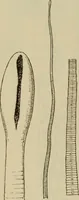 An illustration from The diagnostics of internal medicine : a clinical treatise upon the recognised principles of medical diagnosis, prepared for the use of students and practitioners of medicine / by Glentworth Reeve Butler ... ; with five coloured plates and two hundred and seventy-two illustrations and charts in the text. (1909)
