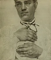 An illustration from The diagnostics of internal medicine : a clinical treatise upon the recognised principles of medical diagnosis, prepared for the use of students and practitioners of medicine / by Glentworth Reeve Butler ... ; with five coloured plates and two hundred and seventy-two illustrations and charts in the text. (1909)