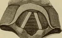 An illustration from The diagnostics of internal medicine : a clinical treatise upon the recognised principles of medical diagnosis, prepared for the use of students and practitioners of medicine / by Glentworth Reeve Butler ... ; with five coloured plates and two hundred and seventy-two illustrations and charts in the text. (1909)