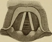 An illustration from The diagnostics of internal medicine : a clinical treatise upon the recognised principles of medical diagnosis, prepared for the use of students and practitioners of medicine / by Glentworth Reeve Butler ... ; with five coloured plates and two hundred and seventy-two illustrations and charts in the text. (1909)