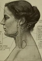 An illustration from The diagnostics of internal medicine : a clinical treatise upon the recognised principles of medical diagnosis, prepared for the use of students and practitioners of medicine / by Glentworth Reeve Butler ... ; with five coloured plates and two hundred and seventy-two illustrations and charts in the text. (1909)