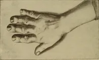 An illustration from The diagnostics of internal medicine : a clinical treatise upon the recognised principles of medical diagnosis, prepared for the use of students and practitioners of medicine / by Glentworth Reeve Butler ... ; with five coloured plates and two hundred and seventy-two illustrations and charts in the text. (1909)
