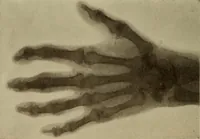 An illustration from The diagnostics of internal medicine : a clinical treatise upon the recognised principles of medical diagnosis, prepared for the use of students and practitioners of medicine / by Glentworth Reeve Butler ... ; with five coloured plates and two hundred and seventy-two illustrations and charts in the text. (1909)