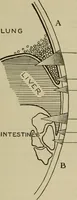 An illustration from The diagnostics of internal medicine : a clinical treatise upon the recognised principles of medical diagnosis, prepared for the use of students and practitioners of medicine / by Glentworth Reeve Butler ... ; with five coloured plates and two hundred and seventy-two illustrations and charts in the text. (1909)