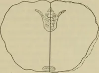 An illustration from The diagnostics of internal medicine : a clinical treatise upon the recognised principles of medical diagnosis, prepared for the use of students and practitioners of medicine / by Glentworth Reeve Butler ... ; with five coloured plates and two hundred and seventy-two illustrations and charts in the text. (1909)