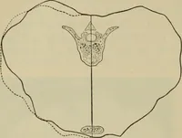 An illustration from The diagnostics of internal medicine : a clinical treatise upon the recognised principles of medical diagnosis, prepared for the use of students and practitioners of medicine / by Glentworth Reeve Butler ... ; with five coloured plates and two hundred and seventy-two illustrations and charts in the text. (1909)