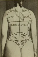 An illustration from The diagnostics of internal medicine : a clinical treatise upon the recognised principles of medical diagnosis, prepared for the use of students and practitioners of medicine / by Glentworth Reeve Butler ... ; with five coloured plates and two hundred and seventy-two illustrations and charts in the text. (1909)
