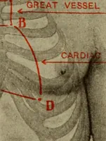 An illustration from The diagnostics of internal medicine : a clinical treatise upon the recognised principles of medical diagnosis, prepared for the use of students and practitioners of medicine / by Glentworth Reeve Butler ... ; with five coloured plates and two hundred and seventy-two illustrations and charts in the text. (1909)