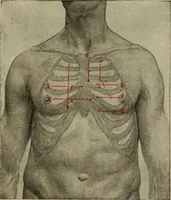An illustration from The diagnostics of internal medicine : a clinical treatise upon the recognised principles of medical diagnosis, prepared for the use of students and practitioners of medicine / by Glentworth Reeve Butler ... ; with five coloured plates and two hundred and seventy-two illustrations and charts in the text. (1909)
