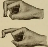An illustration from The diagnostics of internal medicine : a clinical treatise upon the recognised principles of medical diagnosis, prepared for the use of students and practitioners of medicine / by Glentworth Reeve Butler ... ; with five coloured plates and two hundred and seventy-two illustrations and charts in the text. (1909)