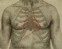 An illustration from The diagnostics of internal medicine : a clinical treatise upon the recognised principles of medical diagnosis, prepared for the use of students and practitioners of medicine / by Glentworth Reeve Butler ... ; with five coloured plates and two hundred and seventy-two illustrations and charts in the text. (1909)