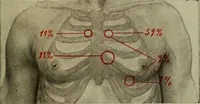 An illustration from The diagnostics of internal medicine : a clinical treatise upon the recognised principles of medical diagnosis, prepared for the use of students and practitioners of medicine / by Glentworth Reeve Butler ... ; with five coloured plates and two hundred and seventy-two illustrations and charts in the text. (1909)
