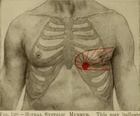 An illustration from The diagnostics of internal medicine : a clinical treatise upon the recognised principles of medical diagnosis, prepared for the use of students and practitioners of medicine / by Glentworth Reeve Butler ... ; with five coloured plates and two hundred and seventy-two illustrations and charts in the text. (1909)