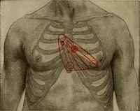 An illustration from The diagnostics of internal medicine : a clinical treatise upon the recognised principles of medical diagnosis, prepared for the use of students and practitioners of medicine / by Glentworth Reeve Butler ... ; with five coloured plates and two hundred and seventy-two illustrations and charts in the text. (1909)