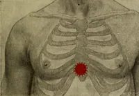 An illustration from The diagnostics of internal medicine : a clinical treatise upon the recognised principles of medical diagnosis, prepared for the use of students and practitioners of medicine / by Glentworth Reeve Butler ... ; with five coloured plates and two hundred and seventy-two illustrations and charts in the text. (1909)