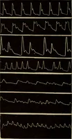 An illustration from The diagnostics of internal medicine : a clinical treatise upon the recognised principles of medical diagnosis, prepared for the use of students and practitioners of medicine / by Glentworth Reeve Butler ... ; with five coloured plates and two hundred and seventy-two illustrations and charts in the text. (1909)