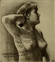An illustration from The diagnostics of internal medicine : a clinical treatise upon the recognised principles of medical diagnosis, prepared for the use of students and practitioners of medicine / by Glentworth Reeve Butler ... ; with five coloured plates and two hundred and seventy-two illustrations and charts in the text. (1909)