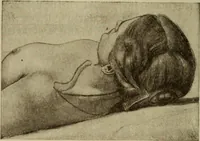 An illustration from The diagnostics of internal medicine : a clinical treatise upon the recognised principles of medical diagnosis, prepared for the use of students and practitioners of medicine / by Glentworth Reeve Butler ... ; with five coloured plates and two hundred and seventy-two illustrations and charts in the text. (1909)