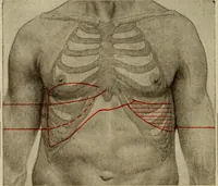 An illustration from The diagnostics of internal medicine : a clinical treatise upon the recognised principles of medical diagnosis, prepared for the use of students and practitioners of medicine / by Glentworth Reeve Butler ... ; with five coloured plates and two hundred and seventy-two illustrations and charts in the text. (1909)