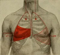 An illustration from The diagnostics of internal medicine : a clinical treatise upon the recognised principles of medical diagnosis, prepared for the use of students and practitioners of medicine / by Glentworth Reeve Butler ... ; with five coloured plates and two hundred and seventy-two illustrations and charts in the text. (1909)