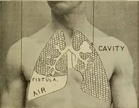 An illustration from The diagnostics of internal medicine : a clinical treatise upon the recognised principles of medical diagnosis, prepared for the use of students and practitioners of medicine / by Glentworth Reeve Butler ... ; with five coloured plates and two hundred and seventy-two illustrations and charts in the text. (1909)