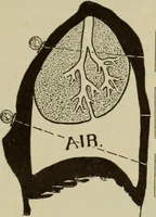 An illustration from The diagnostics of internal medicine : a clinical treatise upon the recognised principles of medical diagnosis, prepared for the use of students and practitioners of medicine / by Glentworth Reeve Butler ... ; with five coloured plates and two hundred and seventy-two illustrations and charts in the text. (1909)