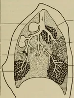 An illustration from The diagnostics of internal medicine : a clinical treatise upon the recognised principles of medical diagnosis, prepared for the use of students and practitioners of medicine / by Glentworth Reeve Butler ... ; with five coloured plates and two hundred and seventy-two illustrations and charts in the text. (1909)
