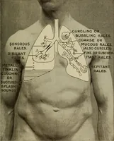 An illustration from The diagnostics of internal medicine : a clinical treatise upon the recognised principles of medical diagnosis, prepared for the use of students and practitioners of medicine / by Glentworth Reeve Butler ... ; with five coloured plates and two hundred and seventy-two illustrations and charts in the text. (1909)
