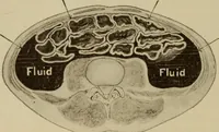 An illustration from The diagnostics of internal medicine : a clinical treatise upon the recognised principles of medical diagnosis, prepared for the use of students and practitioners of medicine / by Glentworth Reeve Butler ... ; with five coloured plates and two hundred and seventy-two illustrations and charts in the text. (1909)