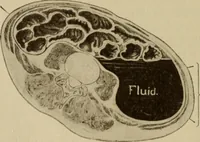 An illustration from The diagnostics of internal medicine : a clinical treatise upon the recognised principles of medical diagnosis, prepared for the use of students and practitioners of medicine / by Glentworth Reeve Butler ... ; with five coloured plates and two hundred and seventy-two illustrations and charts in the text. (1909)