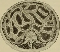 An illustration from The diagnostics of internal medicine : a clinical treatise upon the recognised principles of medical diagnosis, prepared for the use of students and practitioners of medicine / by Glentworth Reeve Butler ... ; with five coloured plates and two hundred and seventy-two illustrations and charts in the text. (1909)