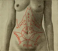 An illustration from The diagnostics of internal medicine : a clinical treatise upon the recognised principles of medical diagnosis, prepared for the use of students and practitioners of medicine / by Glentworth Reeve Butler ... ; with five coloured plates and two hundred and seventy-two illustrations and charts in the text. (1909)