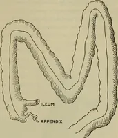 An illustration from The diagnostics of internal medicine : a clinical treatise upon the recognised principles of medical diagnosis, prepared for the use of students and practitioners of medicine / by Glentworth Reeve Butler ... ; with five coloured plates and two hundred and seventy-two illustrations and charts in the text. (1909)