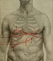 An illustration from The diagnostics of internal medicine : a clinical treatise upon the recognised principles of medical diagnosis, prepared for the use of students and practitioners of medicine / by Glentworth Reeve Butler ... ; with five coloured plates and two hundred and seventy-two illustrations and charts in the text. (1909)