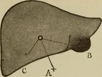 An illustration from The diagnostics of internal medicine : a clinical treatise upon the recognised principles of medical diagnosis, prepared for the use of students and practitioners of medicine / by Glentworth Reeve Butler ... ; with five coloured plates and two hundred and seventy-two illustrations and charts in the text. (1909)