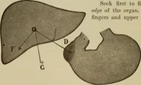 An illustration from The diagnostics of internal medicine : a clinical treatise upon the recognised principles of medical diagnosis, prepared for the use of students and practitioners of medicine / by Glentworth Reeve Butler ... ; with five coloured plates and two hundred and seventy-two illustrations and charts in the text. (1909)