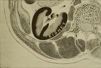 An illustration from The diagnostics of internal medicine : a clinical treatise upon the recognised principles of medical diagnosis, prepared for the use of students and practitioners of medicine / by Glentworth Reeve Butler ... ; with five coloured plates and two hundred and seventy-two illustrations and charts in the text. (1909)
