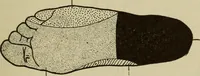 An illustration from The diagnostics of internal medicine : a clinical treatise upon the recognised principles of medical diagnosis, prepared for the use of students and practitioners of medicine / by Glentworth Reeve Butler ... ; with five coloured plates and two hundred and seventy-two illustrations and charts in the text. (1909)