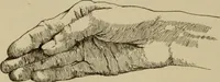 An illustration from The diagnostics of internal medicine : a clinical treatise upon the recognised principles of medical diagnosis, prepared for the use of students and practitioners of medicine / by Glentworth Reeve Butler ... ; with five coloured plates and two hundred and seventy-two illustrations and charts in the text. (1909)