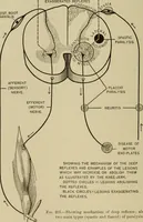 An illustration from The diagnostics of internal medicine : a clinical treatise upon the recognised principles of medical diagnosis, prepared for the use of students and practitioners of medicine / by Glentworth Reeve Butler ... ; with five coloured plates and two hundred and seventy-two illustrations and charts in the text. (1909)