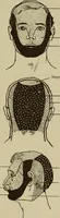 An illustration from The diagnostics of internal medicine : a clinical treatise upon the recognised principles of medical diagnosis, prepared for the use of students and practitioners of medicine / by Glentworth Reeve Butler ... ; with five coloured plates and two hundred and seventy-two illustrations and charts in the text. (1909)