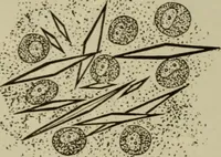 An illustration from The diagnostics of internal medicine : a clinical treatise upon the recognised principles of medical diagnosis, prepared for the use of students and practitioners of medicine / by Glentworth Reeve Butler ... ; with five coloured plates and two hundred and seventy-two illustrations and charts in the text. (1909)
