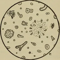 An illustration from The diagnostics of internal medicine : a clinical treatise upon the recognised principles of medical diagnosis, prepared for the use of students and practitioners of medicine / by Glentworth Reeve Butler ... ; with five coloured plates and two hundred and seventy-two illustrations and charts in the text. (1909)